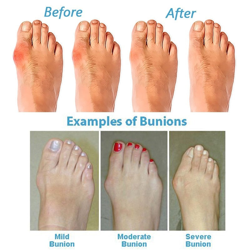 Orthopedic Bunion Corrector Sandals