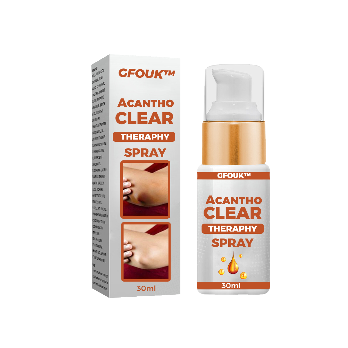 GFOUK™ AcanthoClear Therapy Spray