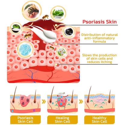 GFOUK™️ BeeVenom Psoriasis Treatment Cream