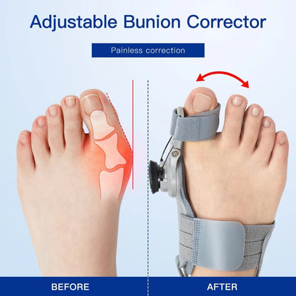 Ergonomic Bunion Fix