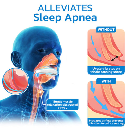 GFOUK™ WellSleep Apnea Oral Appliances