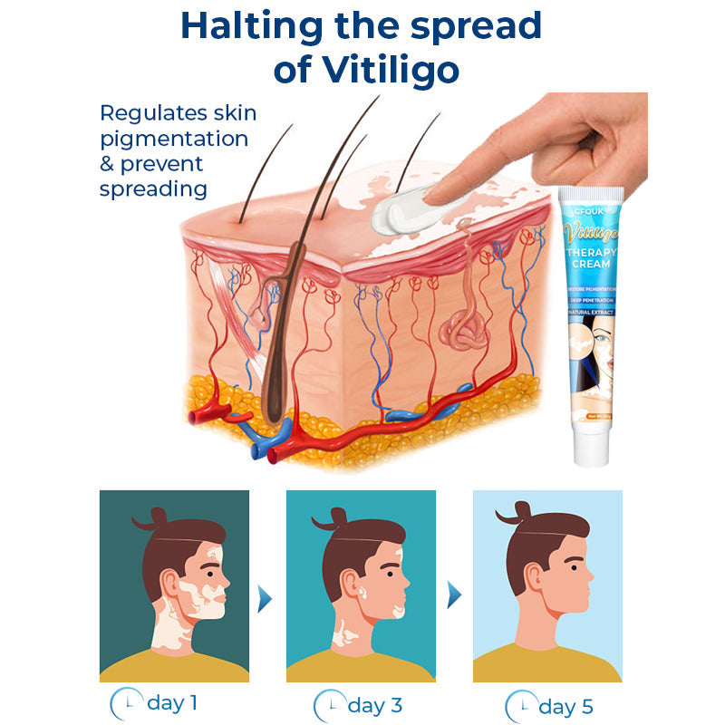 GFOUK™ Vitiligo Therapy Cream