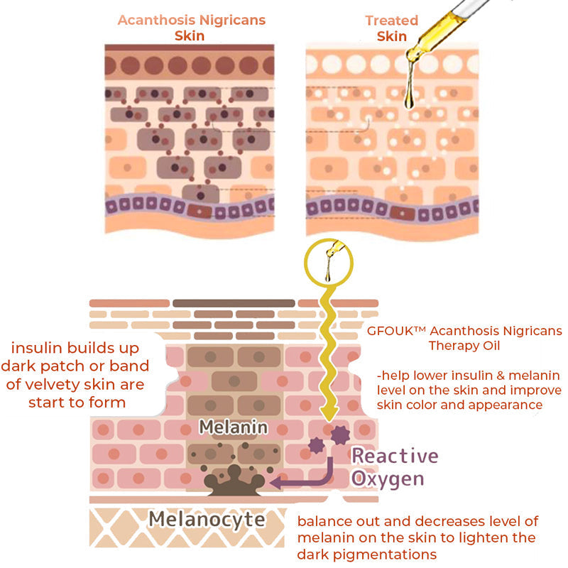 GFOUK™ Acanthosis Nigricans Therapy Oil