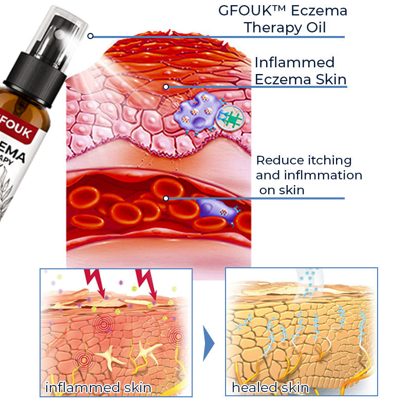 GFOUK™ Eczema Therapy Spray