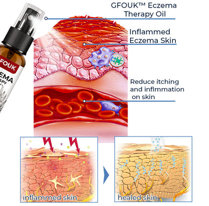 GFOUK™ Eczema Therapy Spray